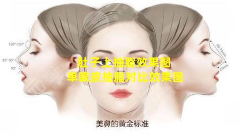 肚子上抽脂效果图 单眼皮抽脂对比效果图